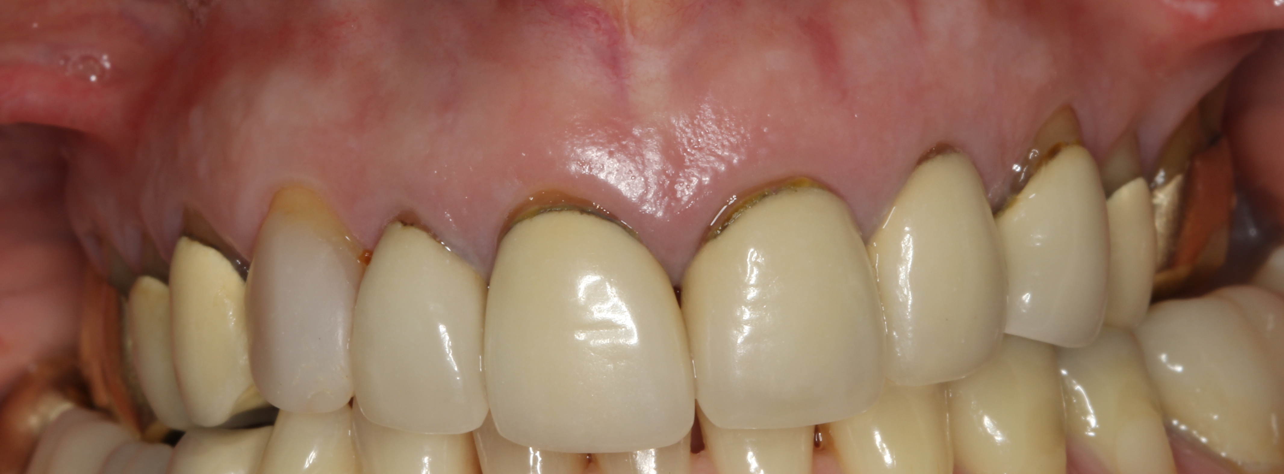 Significant Gingival Recession