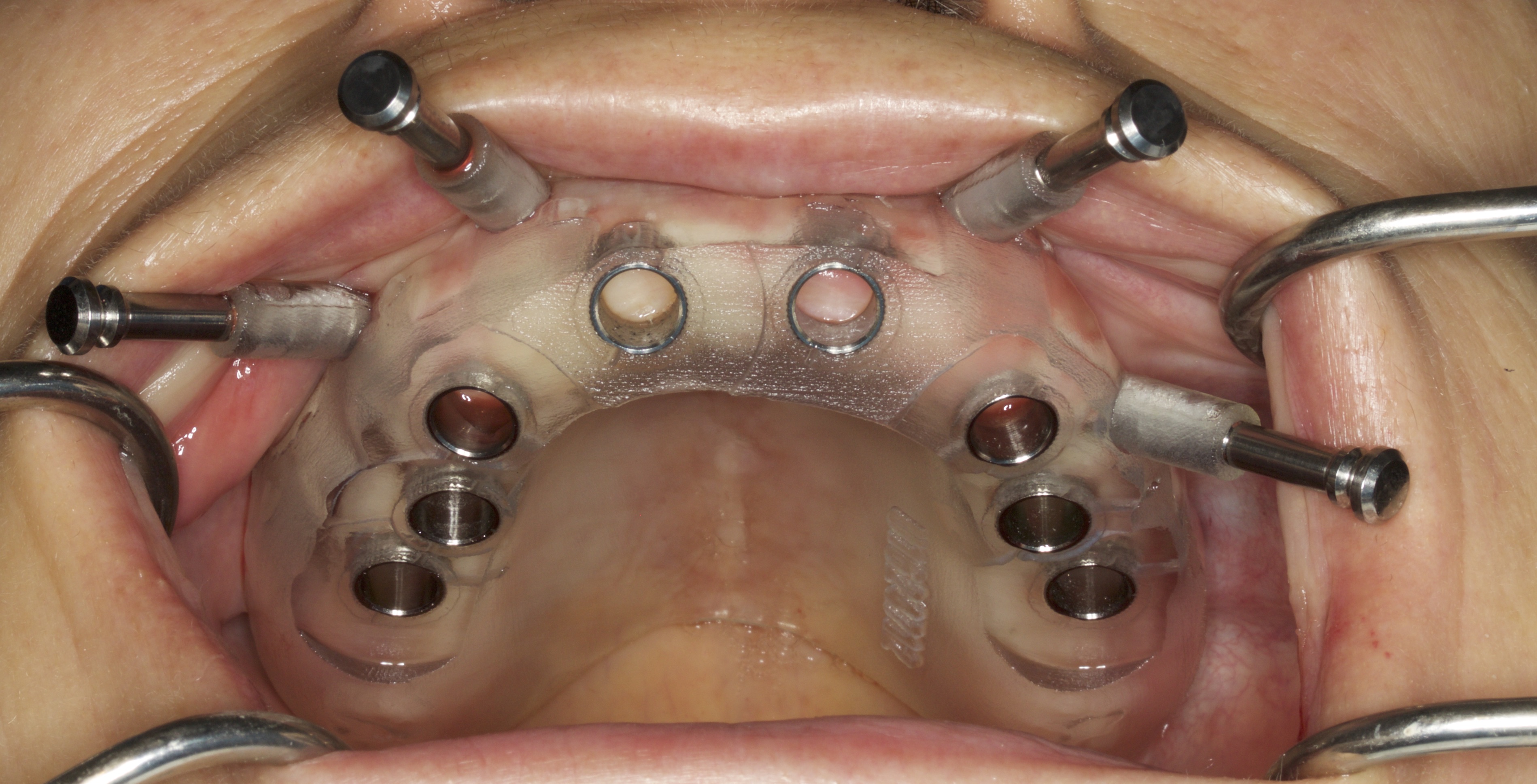CBCT Guided Implant Surgery
