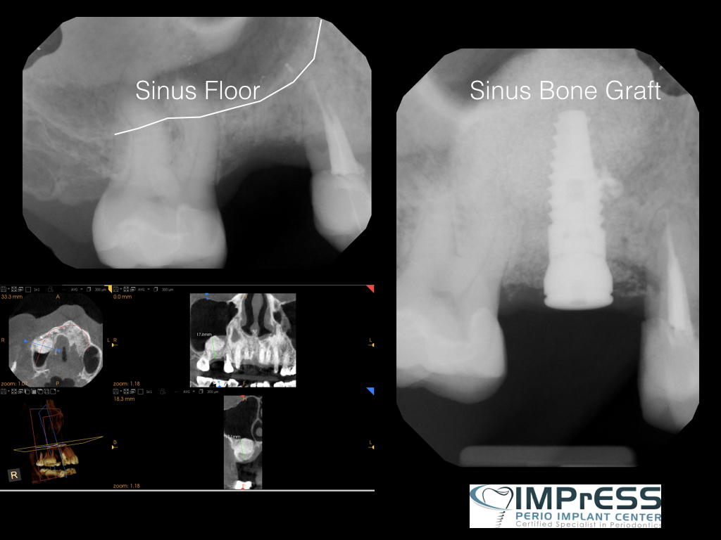 Sinus Lift Surgery Vancouver IMPrESS Perio Implant Center