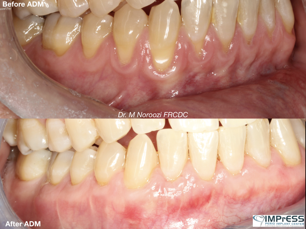 Allograft Dermal Matrix