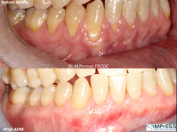 Allograft Dermal Matrix