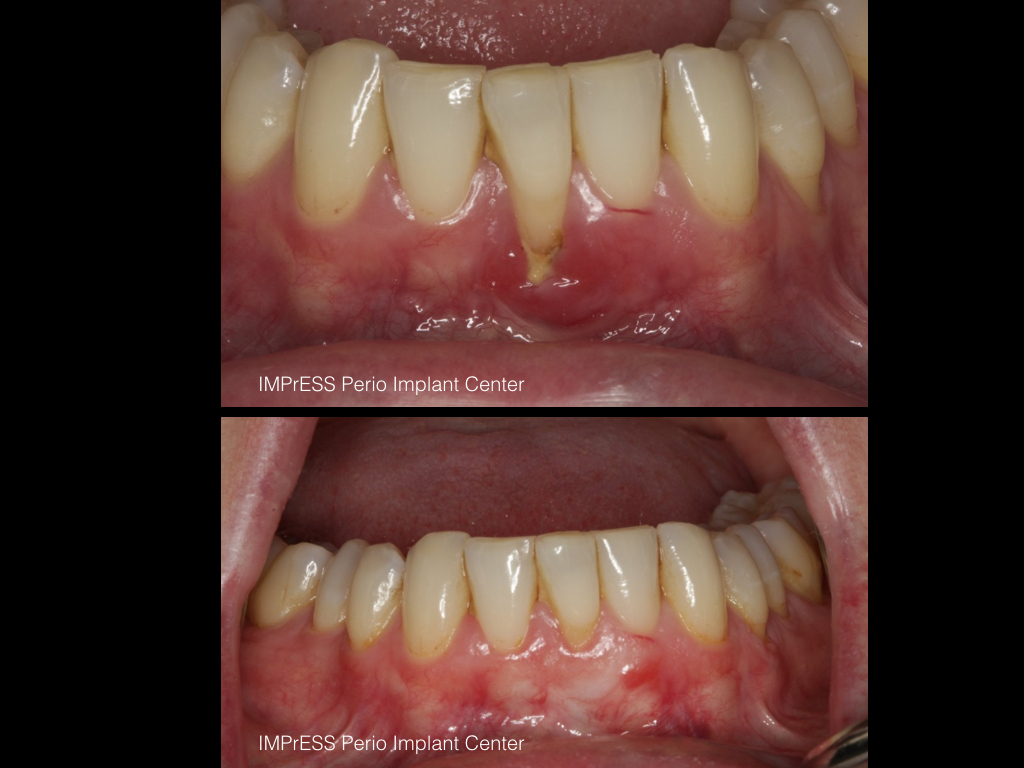 Connective Tissue Graft