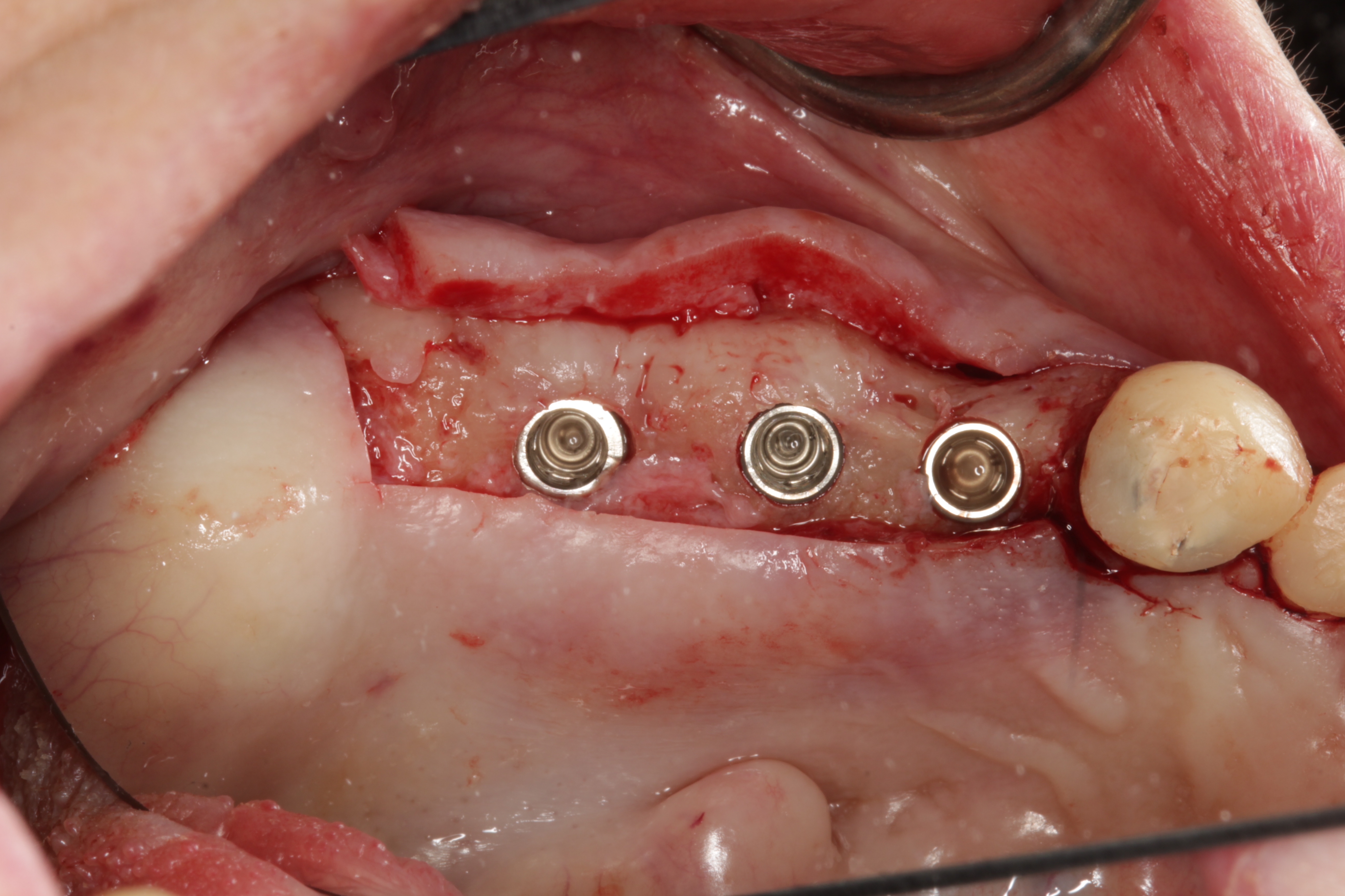 Implant Surgery with Osteotome Sinus