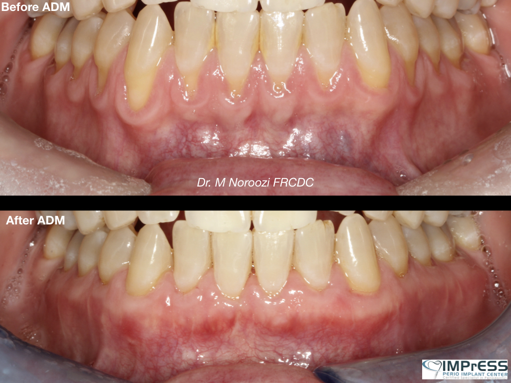 Allograft Dermal Matrix