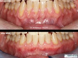 Allograft Dermal Matrix