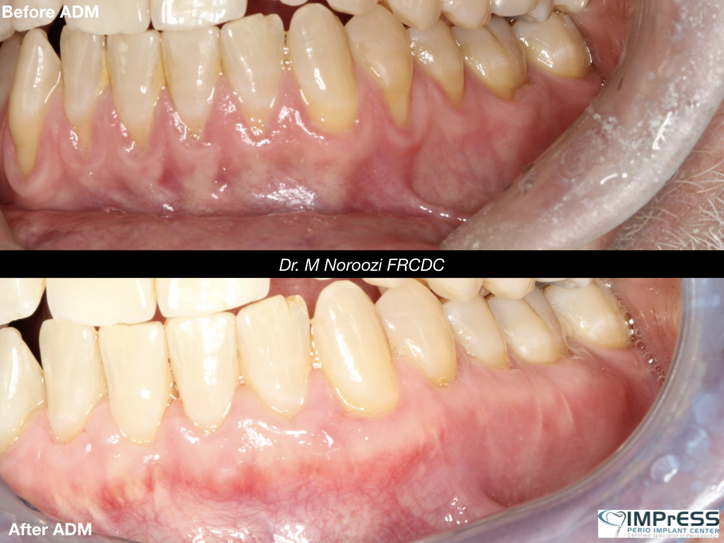 Allograft Dermal Matrix