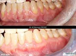 Allograft Dermal Matrix
