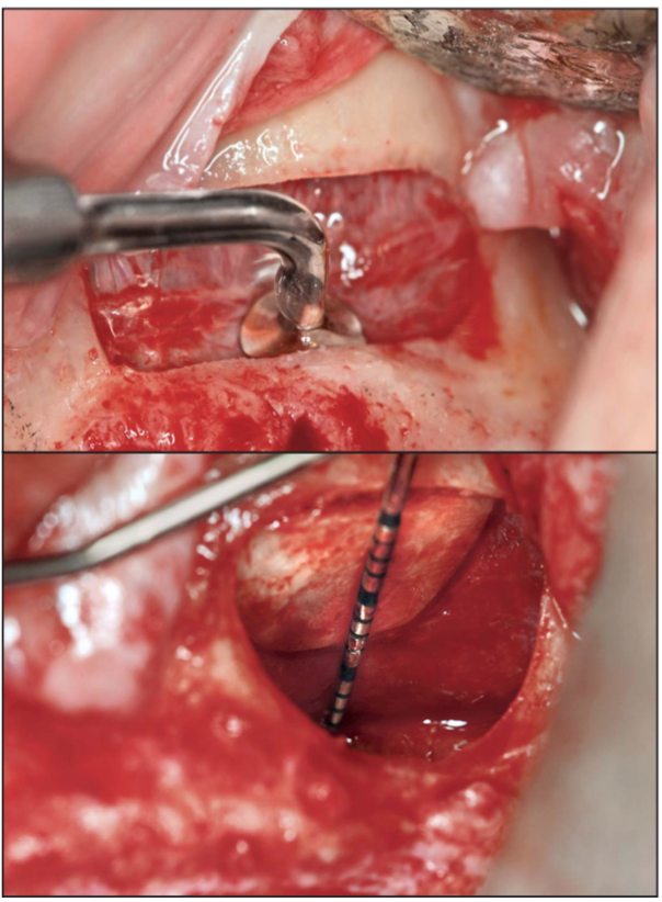 IMPrESS Perio Implant Center Sinus Lift Surgery