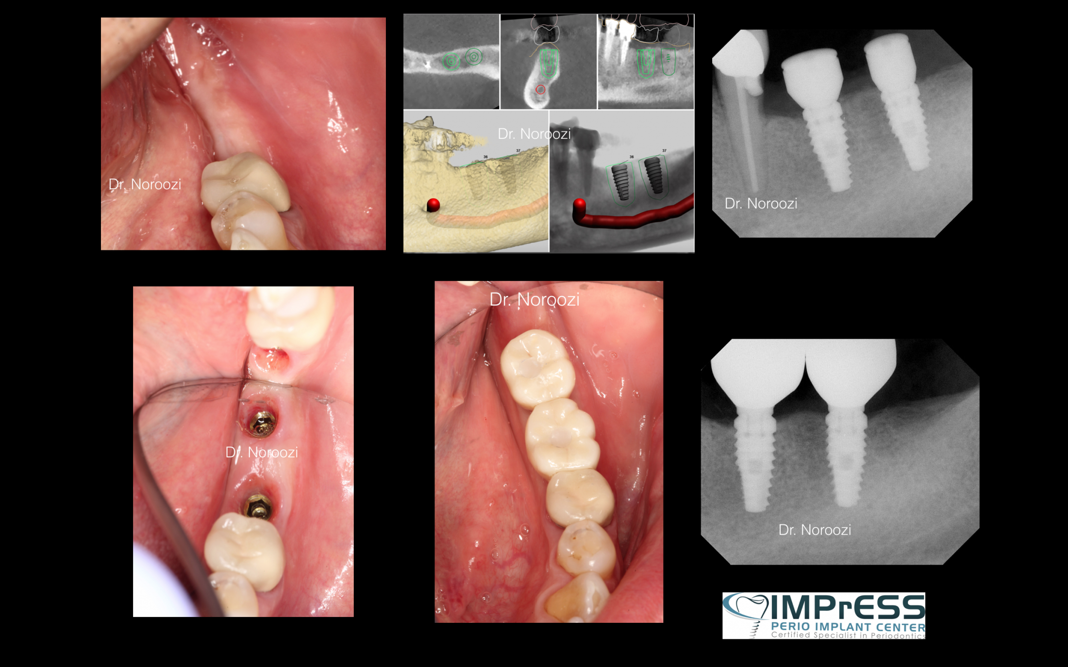 Computer Guided Implant Surgery