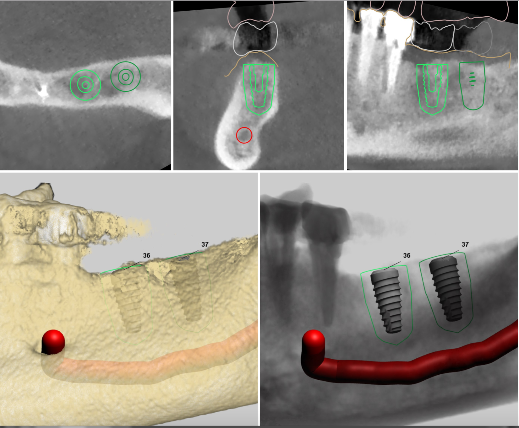 Vancouver Dental Implants IMPrESS Perio Implant Center Vancouver BC
