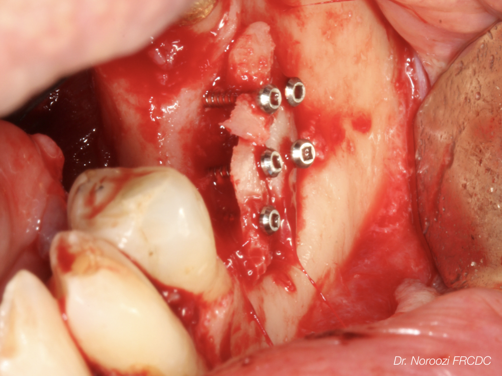 Bone Block Graft for Implants Dr