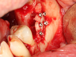 Bone Block Graft for Implants Dr