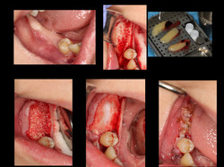 Bone Grafting for Implant Dr. Noroozi.001