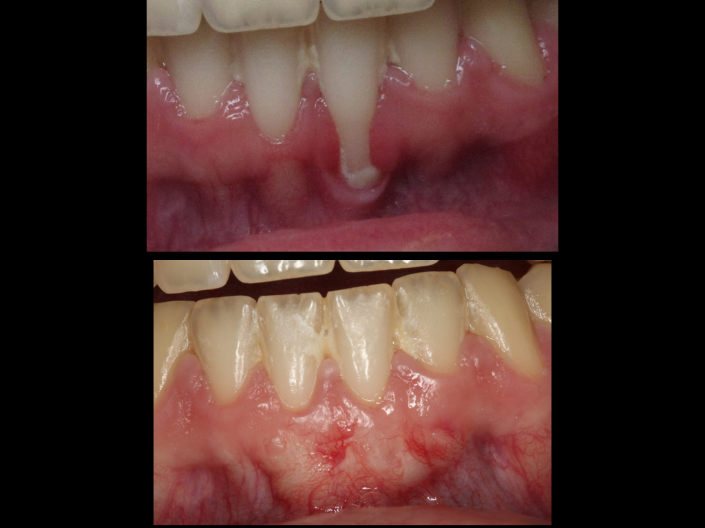 Connective Tissue Graft