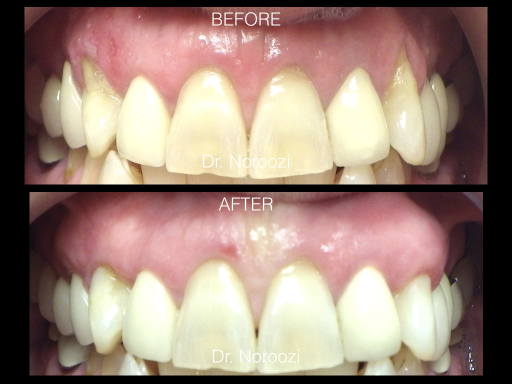 Gum Grafting for Gum Recession Dr. Noroozi I.001