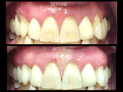 Gum Grafting for Gum Recession Dr. Noroozi I.001