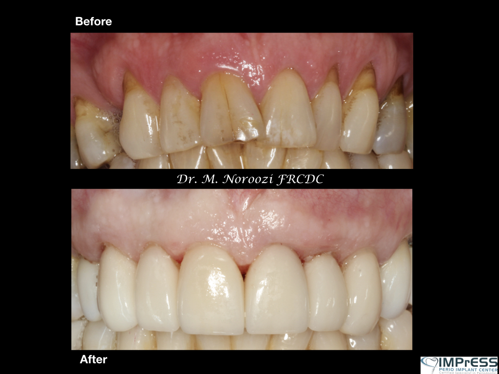 Gum Graft Altenative Cosmetic Dentistry