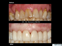 Gum Graft Altenative Cosmetic Dentistry