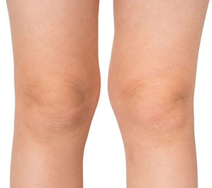 Knock Knees