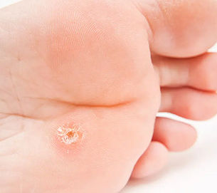 Warts on Children’s Feet