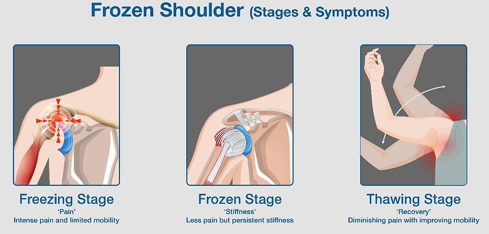 Stages Of Frozen Shoulder