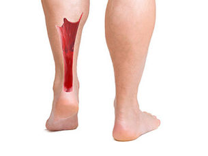 Achilles Tendon