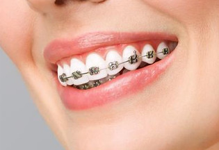 Invisalign, Aparelhos Autoligado Estético e Metálico, Lingual