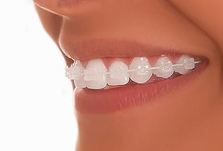 Aparelho Autoligado Estético