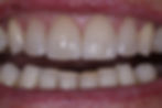 Fall 3.2  Front mit Kronen nachher