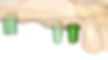 Fall 6.1 Digitale Implantatplanung.jpeg
