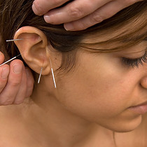acupuncture auriculaire