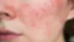 Close-up of a person's cheek with red, inflamed skin and acne. The texture is rough, and the mood suggests irritation.