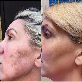 before and after on a woman with melasma. treatment by gillian our certified advanced esthetician and a local nurse practitioner. discoloration significantly improved.