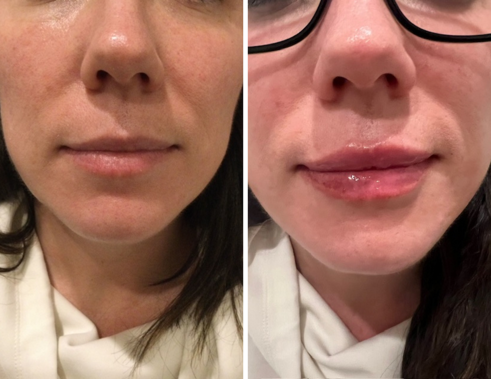 Before and after filler results