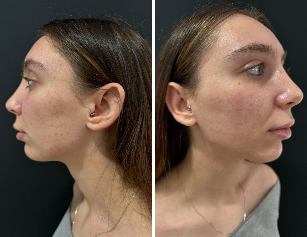 Before and after filler results