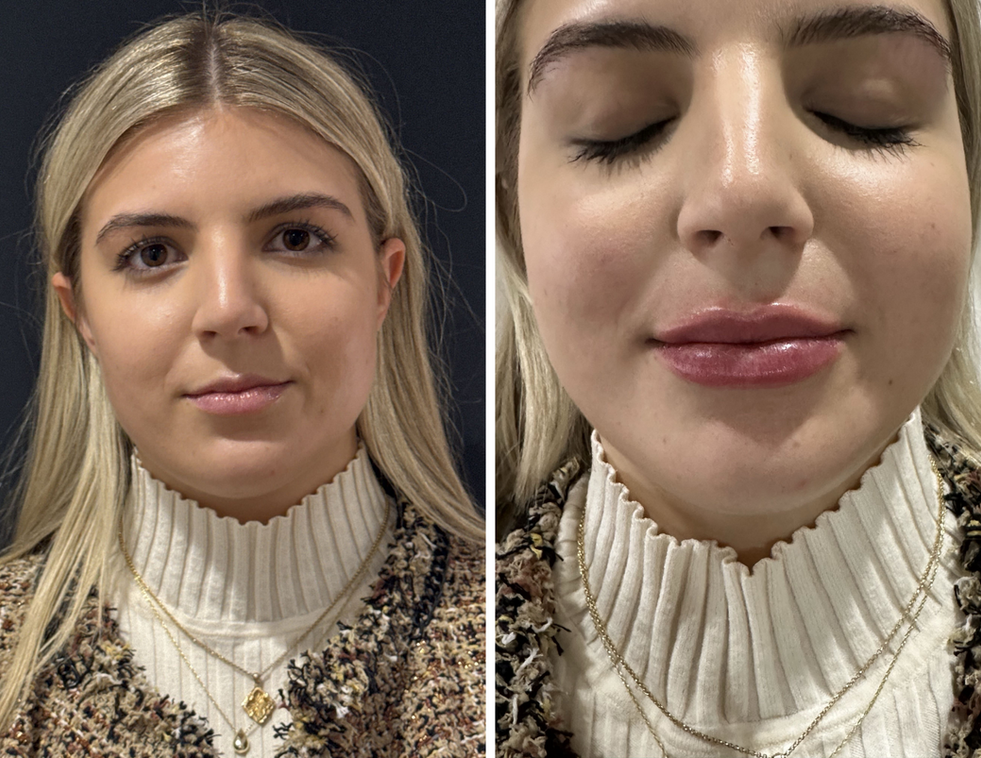 Before and after filler results