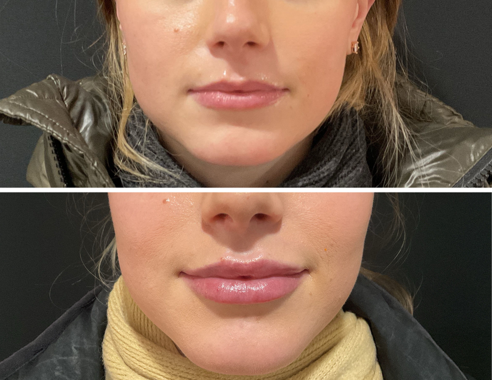 Before and after lip filler results