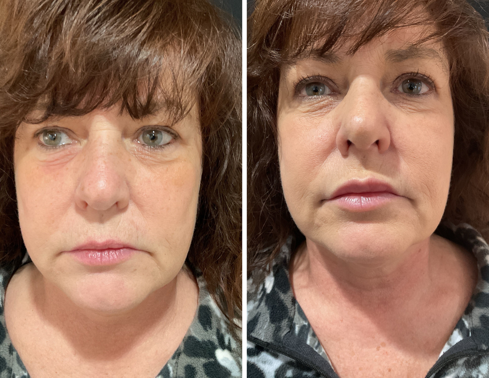 Before and after filler results