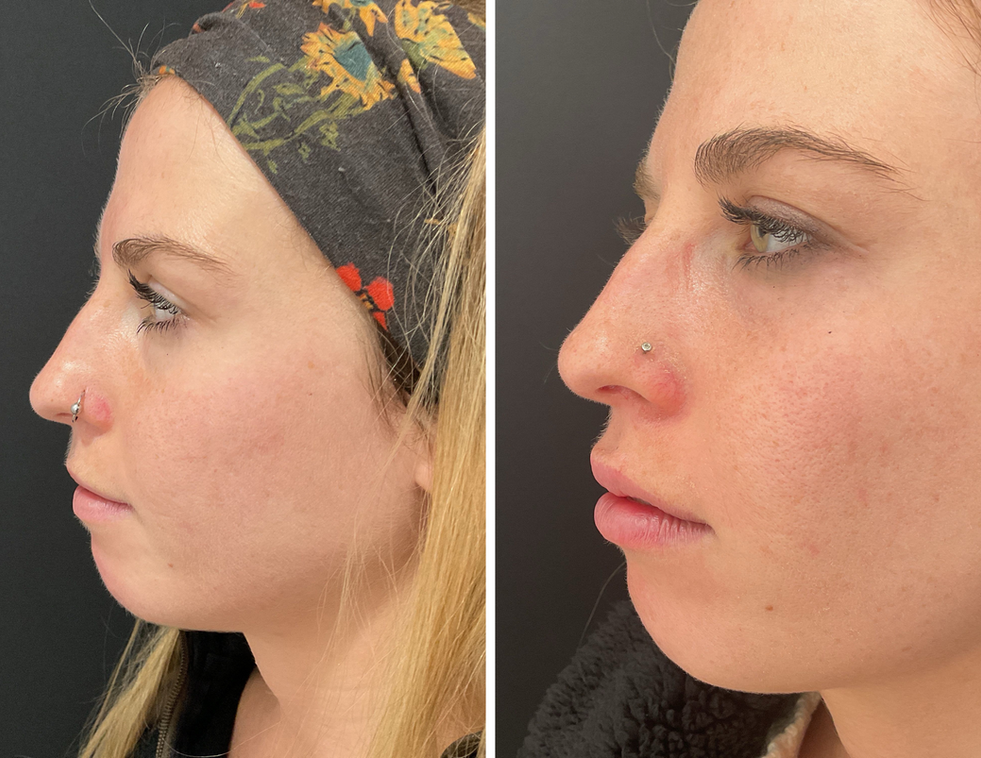Before and after filler results