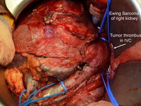 Rare Pediatric Renal Tumors
