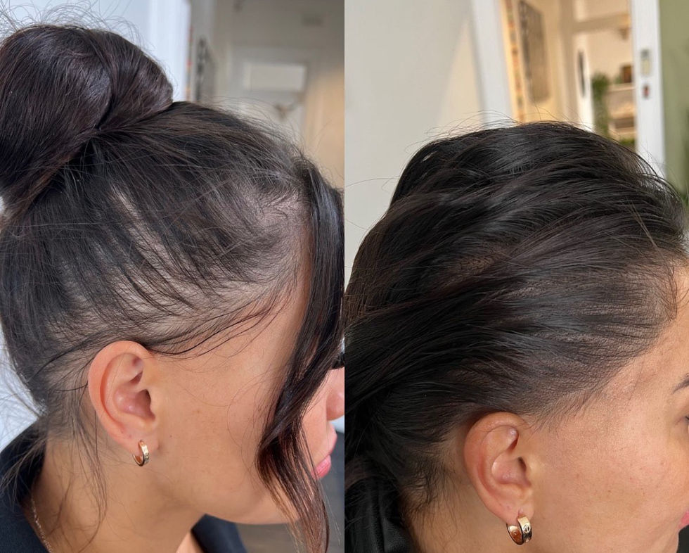 smp scalp micropigmentation 1