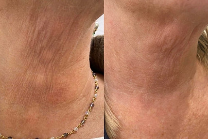 pdo non surgical threads lift neck