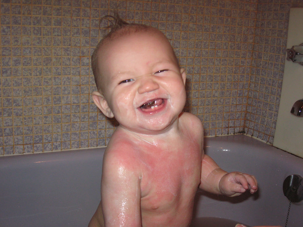 Danek with his eczema flare-ups. He was covered head to toe from age 6 months.