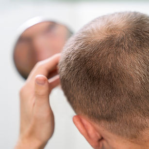hair-loss_man.jpg