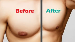 Why Opt Surgical Procedure For Gyne ..comastia To Get Correct Chest Shape In Men?