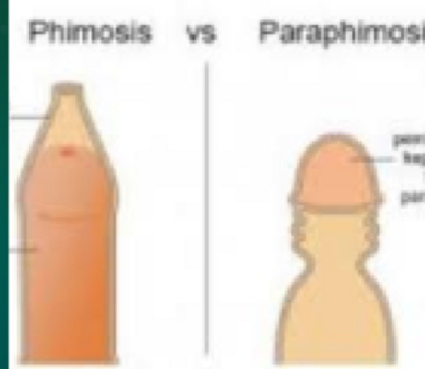 Phimosis vs paraphimosis