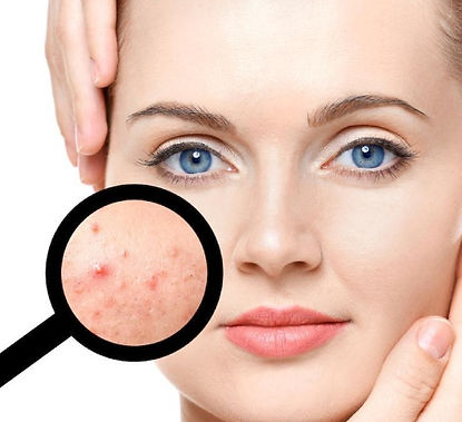 Acne Treatment