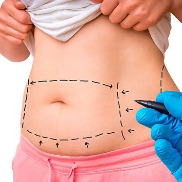 Liposuction