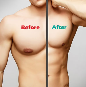 Gynecomastia