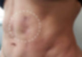 Fibrosis after liposuction